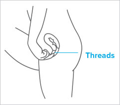 check-1 Fingers checking Paragard threads