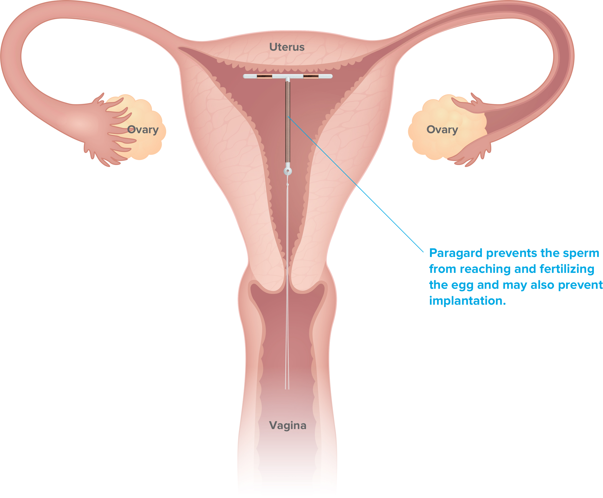 Paragard prevents the sperm from reaching and fertilizing the egg and may also prevent implantation.