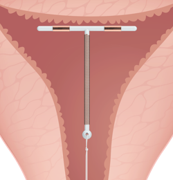 Paragard Inside Uterus