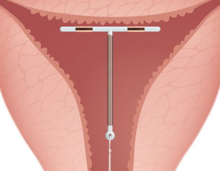 Paragard Inside Uterus