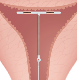 Paragard Inside Uterus