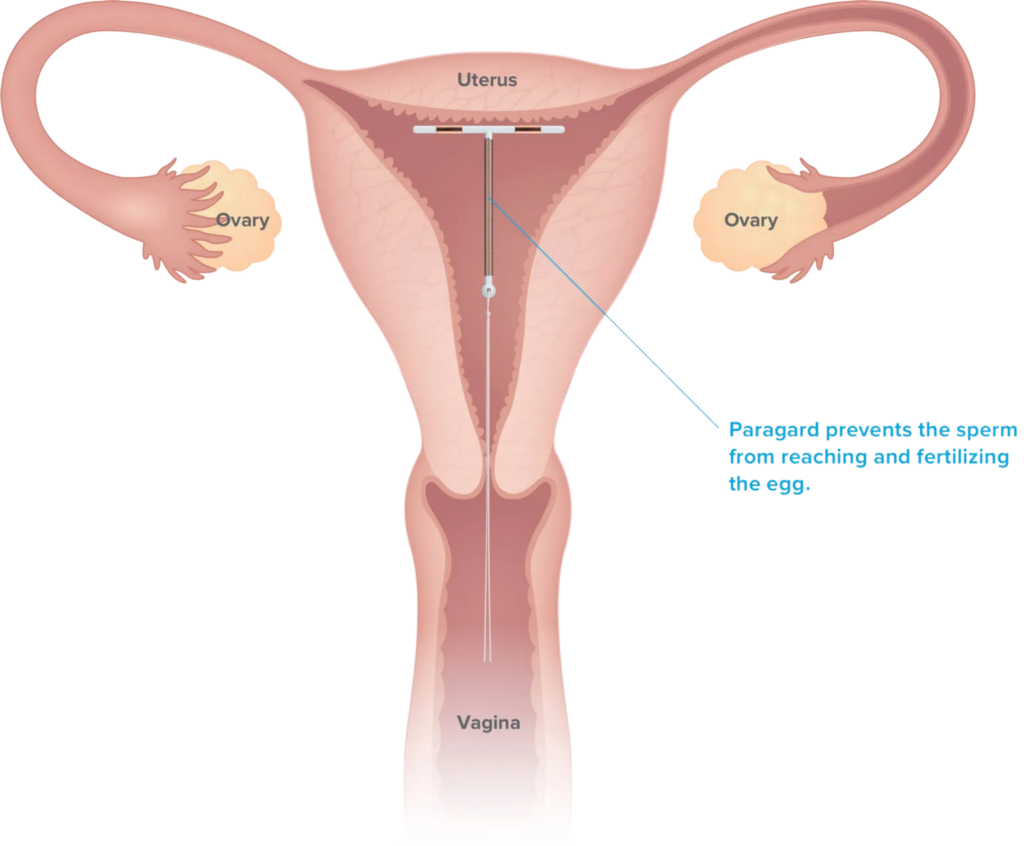 Diagram of uterus